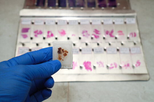 Scientist's hand wearing blue gloves holding a paraffin block of human tissue against a background of a collection of defocused human tissue slides