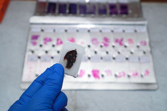 Scientist's hand wearing blue gloves holding a paraffin block of human tissue against a background of a collection of defocused human tissue slides