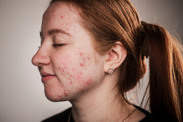 Pimple acne. Skin texture background. Closeup acne pimple. Problem skincare. Pimples, acne, pores, scars. Natural skin. Skin care concept. Acne treatment. Pimples on skin.