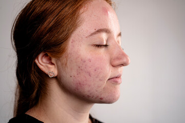 Skin acne background. Closeup acne pimple. Treatment for acne skin. Problem skincare. Pimples, acne, pores, scars. Natural skin. Skin care treatment. Pimples on face.