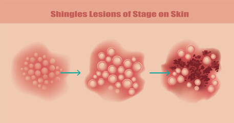Shingles Lesions of Stage on Skin