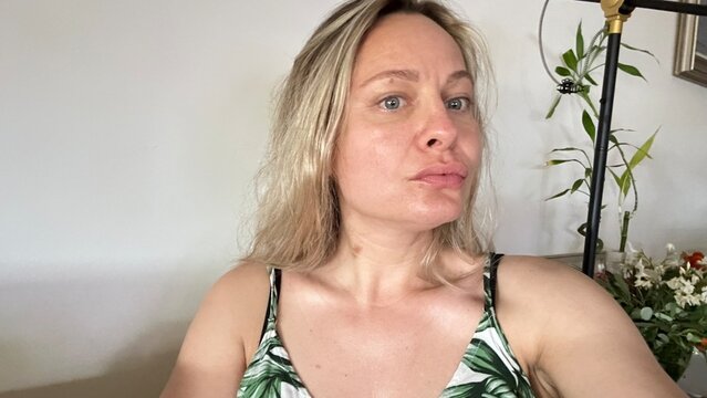 una mujer joven  con la cara hinchada despu&eacute;s de la operaci&oacute;n endoliftihg 