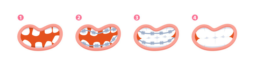 Braces teeth steps from diastema teeth to healthy teeth illustration vector design on white background. Dental care concept.