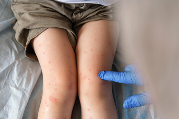 Doctor examining child with bodily red rash. Kid allergy closeup. Little baby scratches an...