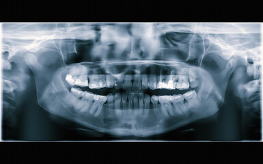 Artistic version of Panoramic dental X-ray for educational purposes