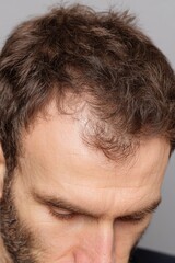 Obraz premium Close-Up of Man's Hairline Showing Thinning Hair, Depicting Hair Loss Concerns and Personal Care : Generative AI