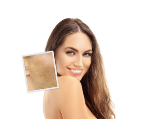 Dark spots, freckles,hyperpigmentation(melasma or chloasma),concept- skin lightening, skin...