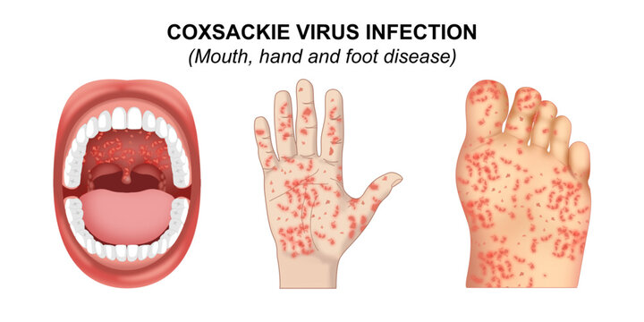 Coxsackie Virus Infection Mouth Hand and Throat Disease