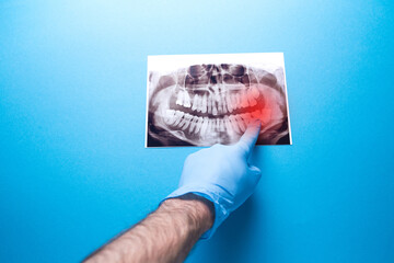 A dentist points to a problem area on a dental X-ray, highlighted in red. Concept of toothache and dental examination.