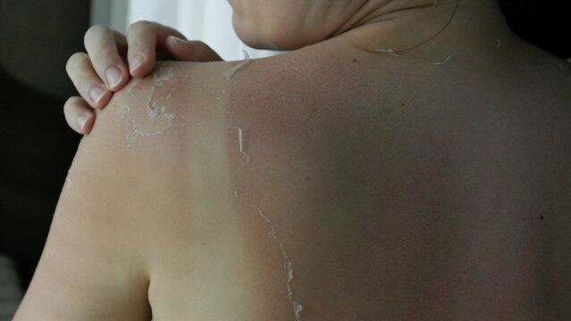 Sunburned shoulder with peeling skin and soft natural light &ndash; perfect for skincare, health, or summer-related concepts.