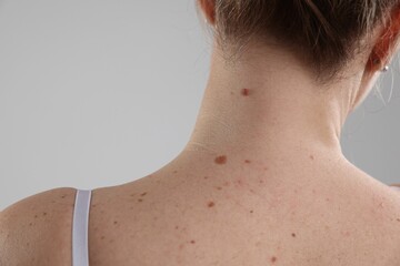 Woman with moles on her body against light background, closeup
