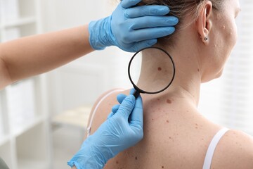 Doctor examining woman's moles in hospital, closeup