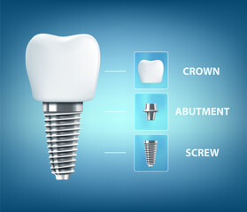 Structure of human tooth dental implant. Vector illustration