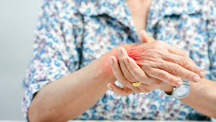 Elderly woman holding painful swollen hand, showing signs of arthritis inflammation, joint pain, and discomfort, wearing floral shirt and gold ring, health and aging concept