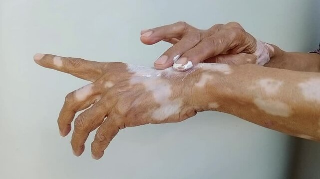 The hand of an asian old woman with a skin problem called vitiligo is being applied with cream.