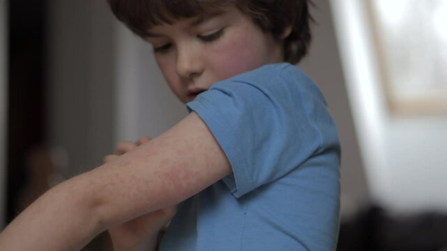 Child Scratching Red Rash on Hand. Boy Scratches Atopic Skin. Dermatitis, Diathesis, Hives Allergy on Child Body and Face. Irritation and Pruritus. Boy Having Allergic Reaction on Skin to Food.