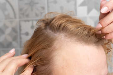 Obraz premium Close-up of woman parting hair to show thinning and sparse growth near hairline. Ideal for topics on hair loss, regrowth, scalp care, or dermatology visuals.