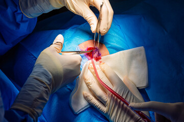 Dermatological surgery in the operating room. Cutting of the lesion and aspiration of fluids.