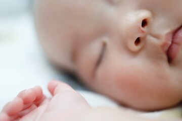 鼻に自分の爪でつけた引っ掻き傷がある赤ちゃん