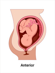 Anterior baby positions in the uterus during pregnancy. Pathology. Detailed medical vector illustration. Fetus with umbilical cord and placenta.
