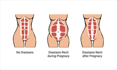 Different types of Diastasis. Diastasis in a woman before, during and after pregnancy. The anatomy of a Woman. A woman's muscular corset before and after childbirth. Vector illustration
