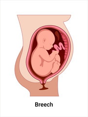 Breech baby positions in the uterus during pregnancy. Pathology. Detailed medical vector illustration. Fetus with umbilical cord and placenta.
