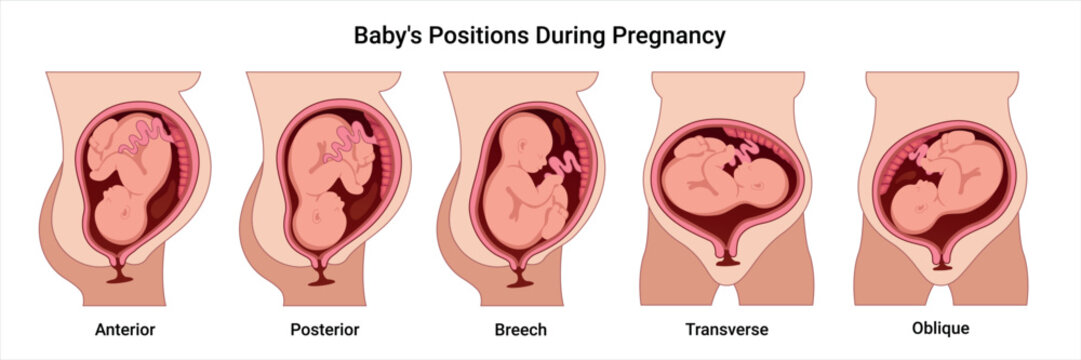 Different baby positions in the uterus during pregnancy. Anterior, Posterior, Breech, Transverse, Oblique positions. Pathology. Detailed medical vector illustration. Fetus with umbilical cord 