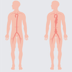 abdominal aortic aneurysm,heart aorta attack, aortic arch bulge open,vein clots stent stroke Marfan root left graft, hernia vessel pain High blood kidney damage Turner, stomach Pain