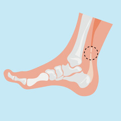 Achilles tendinopathy, human leg ,skeleton ,pain, tendon, medical tendinopathy, rupture, red, disease ,viruses ,disorder, anatomy , inflammation, foot, injury ,rotator cuff,pink
