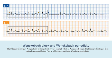 When the PR interval changes and no P wave is blocked, it can only be called the Wenckebach periodidty. Only when the P wave is blocked can it be called Wenckebach block.
