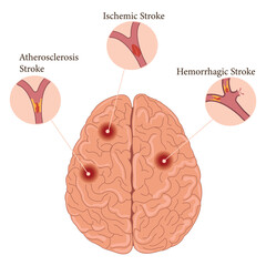 Brain stroke types infographic: ischemic, hemorrhagic, and atherosclerosis stroke illustration