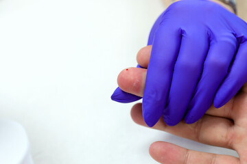 A person's finger is pricked by a doctor to collect a drop of blood for a medical test.