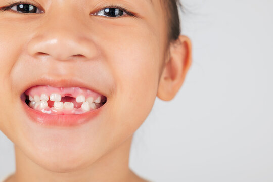 A smiling girl shows her missing tooth. The dentist discusses tooth loss and dental care, highlighting the natural process of losing baby teeth and growing new ones. close up
