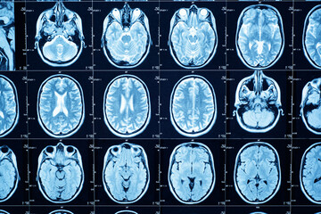 Closeup of a CT scan with brain. Medical, science and education mri brain background. Magnetic resonance imaging.