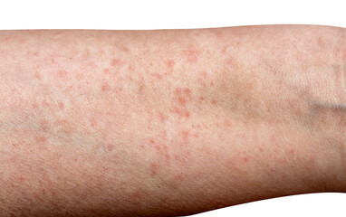 Dermatology medical concept. Female arm with allergic reaction isolated on white background. Close up shot of allergic skin irritation with red spots and rash
