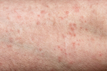 Dermatology medical concept. Female arm with allergic reaction. Close up shot of allergic skin irritation with red spots and rash