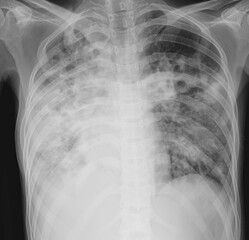 chest x ray pulmonary TB ,lung tb 