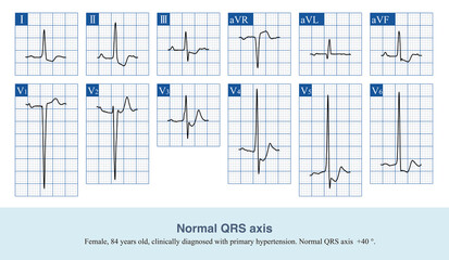 When the frontal QRS axis is +40 °, the QRS main waves in leads I and III are both positive.
