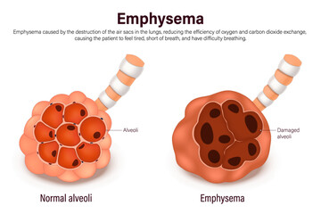 Emphysema. Comparison between normal alveoli and emphysema. Lung diseases anatomy. Human respiratory system.