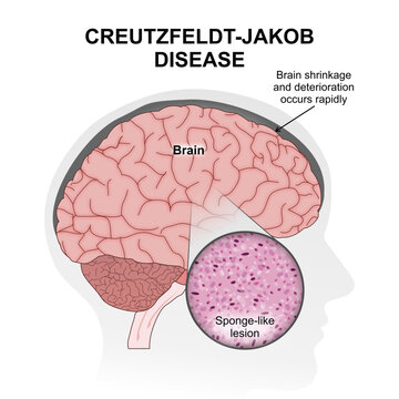 Creutzfeldt-Jakob disease brain Illustration