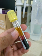 Hand Holding Yellow-Cap Vacutainer Blood Sample Tube in Hospital Lab