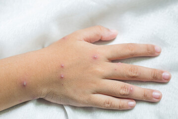 Blisters occur in various areas on the skin of the body.