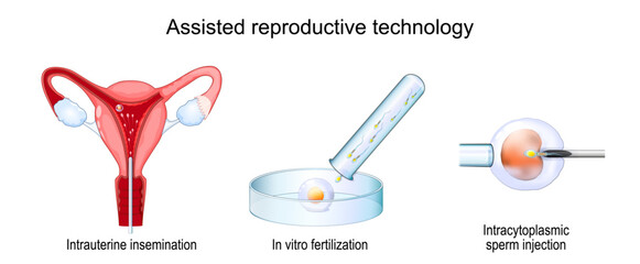 Assisted reproductive technology. In vitro fertilization.