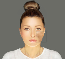 Dark spots, freckles,hyperpigmentation(melasma or chloasma),concept- skin lightening, skin...