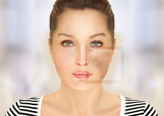 Dark spots, freckles,hyperpigmentation(melasma or chloasma),concept- skin lightening, skin...