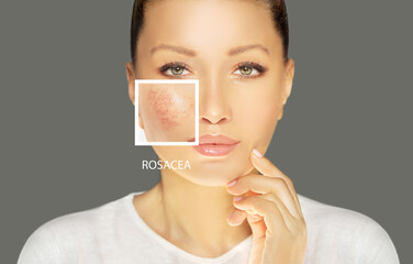 Rosacea ,facial redness.Before and after	