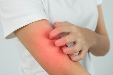 skin problem and beauty. Young woman scratch body has itchy skin from skin allergic, steroid allergy, sensitive skin, red from sunburn, chemical allergy, rash, insect bites, Seborrheic Dermatitis.
