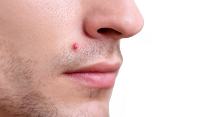 Close up of a herpes cold sore virus appearing on a man's face, highlighting the contagious nature of the infection with a transparent background for easy integration into various projects