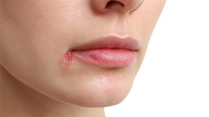 Close up of a woman's mouth showing a herpes simplex virus type 1 infection, featuring blisters and inflammation at the lip corner on a transparent background