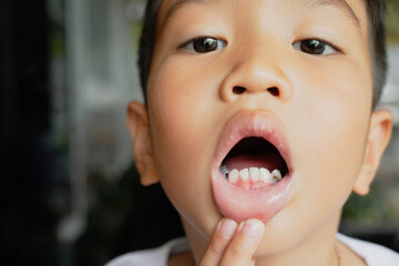 This boy lost his teeth from eating sweets and nibbles, which is likely due to natural loss. His smile reveals gaps where teeth used to be, giving him an attractive, young, and cheerful appearance.